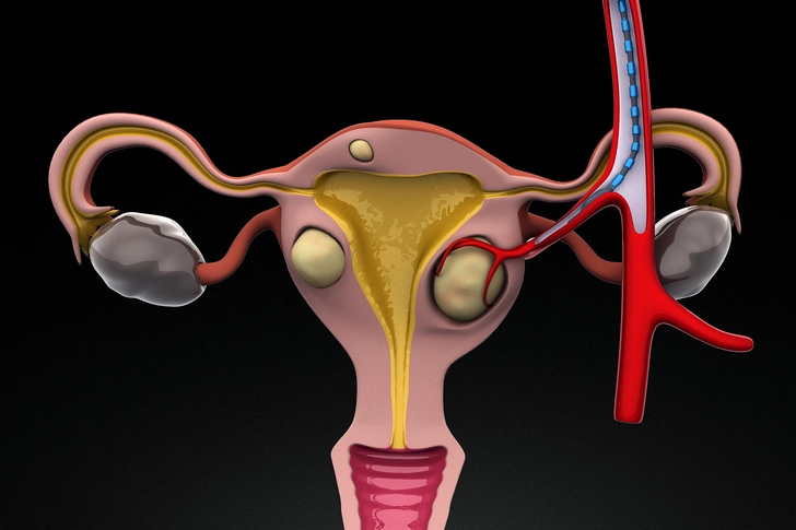 Uterine Artery Embolization (UAE) Uterine Artery Embolization (UAE)