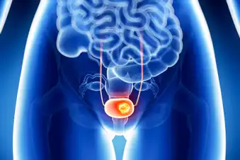 Learn All About Bladder Cancer Learn All About Bladder Cancer