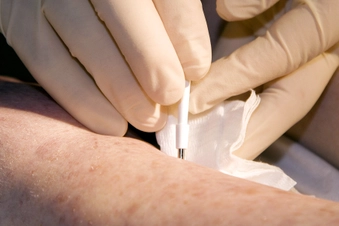 Insist on a Skin Biopsy