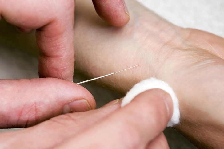 Acupuncture