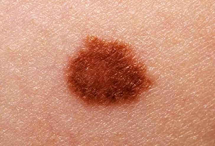 Skin Cancer