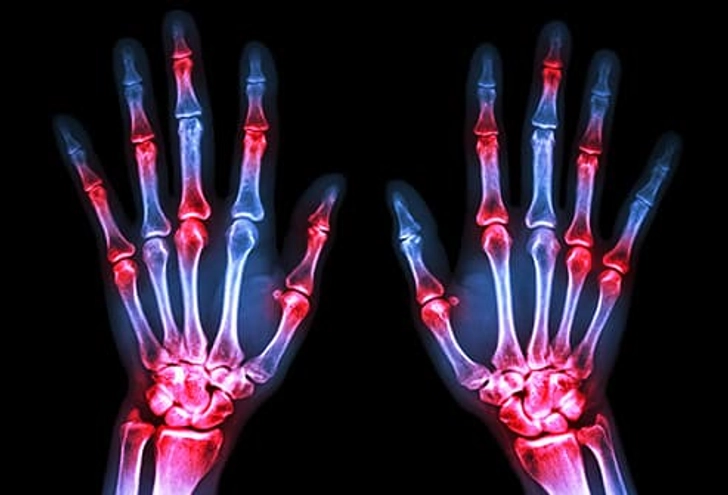 Arthritis