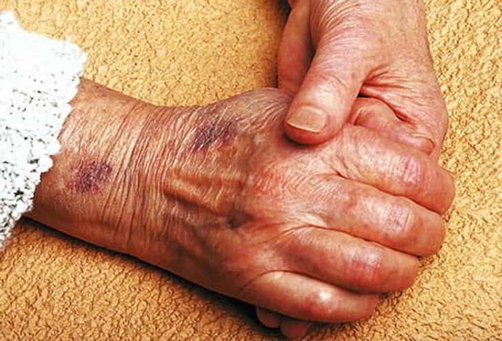 Bruising
