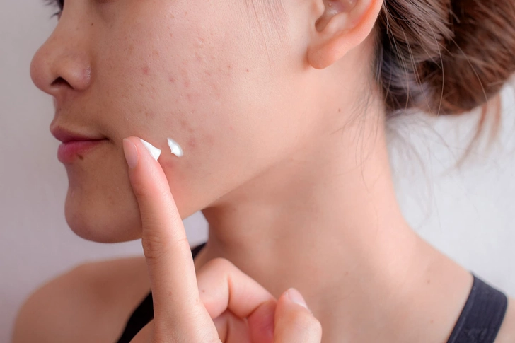 Acne Acne