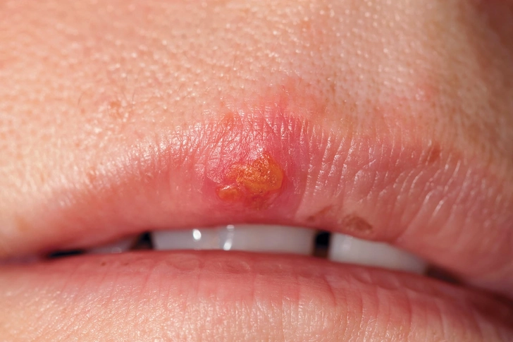Cold Sores