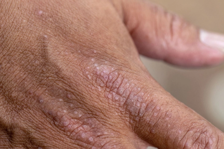 Dermatitis