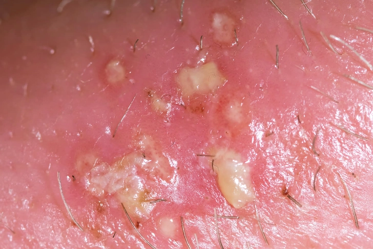 Genital Herpes