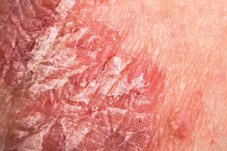 Psoriasis