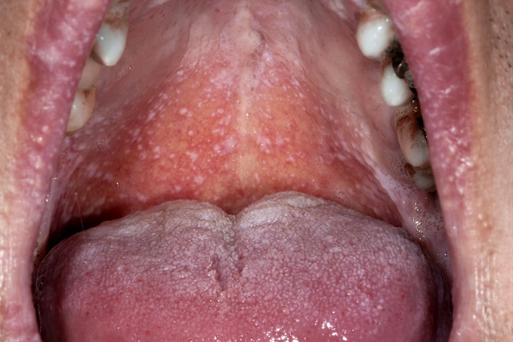 Oral Lichen Planus