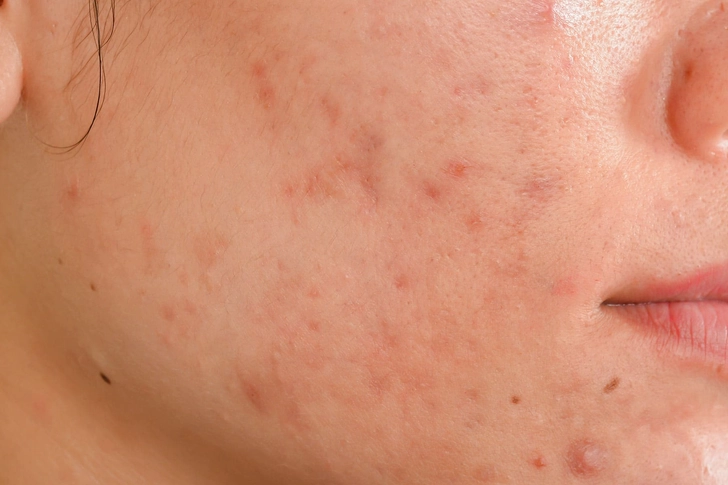 Acne Acne