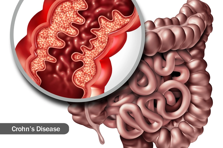 Conditions That Cause Canker Sores Conditions That Cause Canker Sores