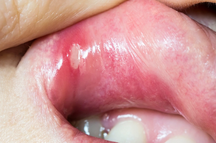 Minor Canker Sores Minor Canker Sores