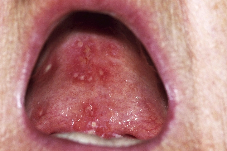 Herpetiform Canker Sores Herpetiform Canker Sores