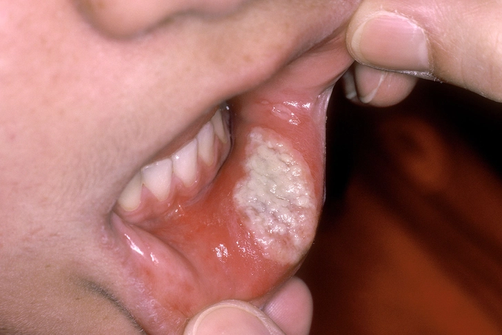 Major Canker Sores Major Canker Sores