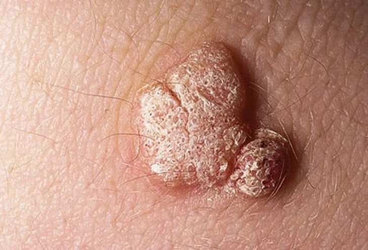 Signs of HPV