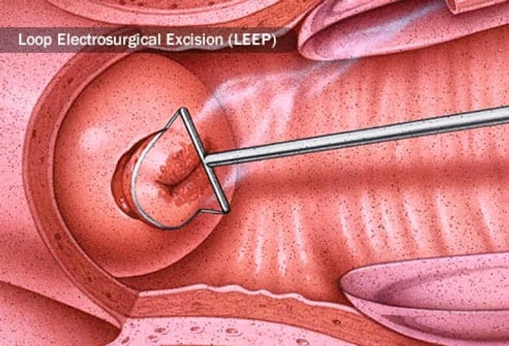 Treatment for Cervical Cell Changes