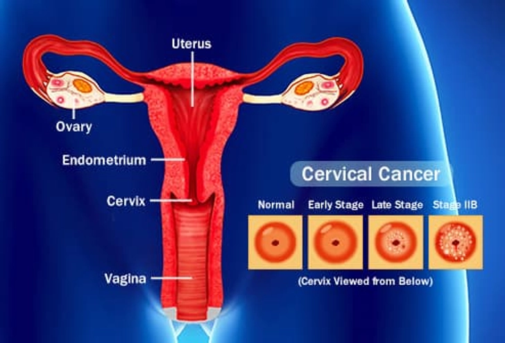 Types of Cancer Linked to HPV