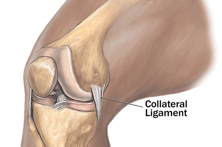 Collateral Ligament Tear