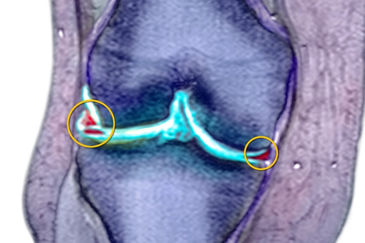 Meniscus Tear