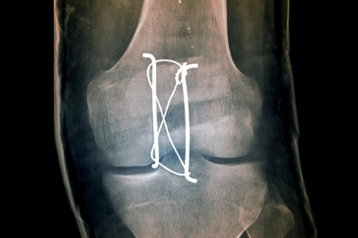 Patella Fracture Repair Patella Fracture Repair