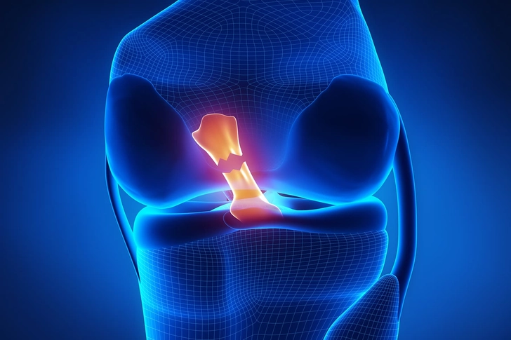 Cruciate Ligament Tear