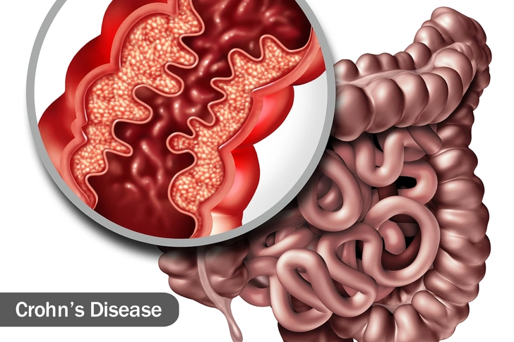 Inflammatory Bowel Diseases Inflammatory Bowel Diseases