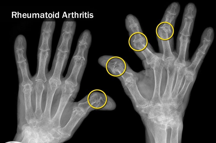 Autoimmune Diseases