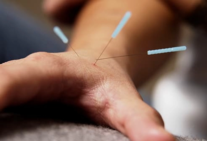 Acupuncture Acupuncture