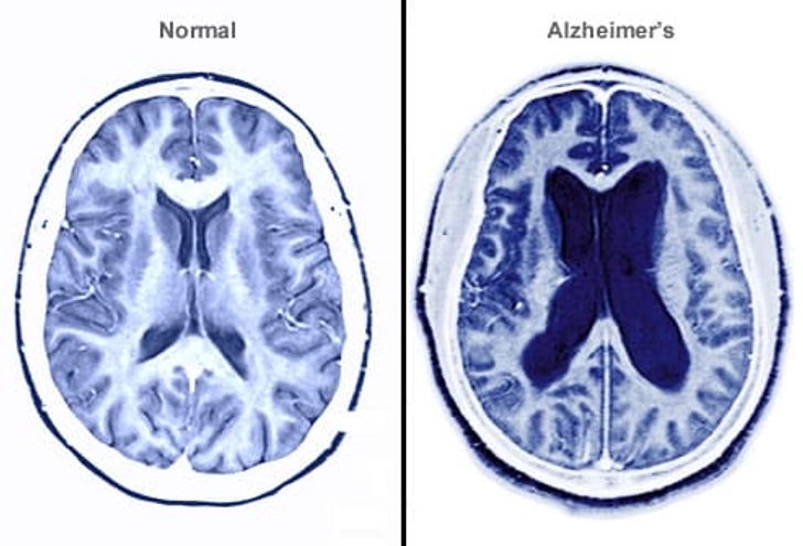 What Happens to the Brain?