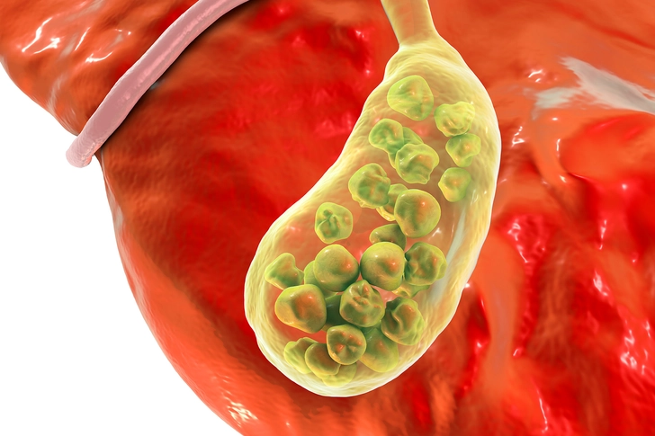 Common Cause: Gallstones