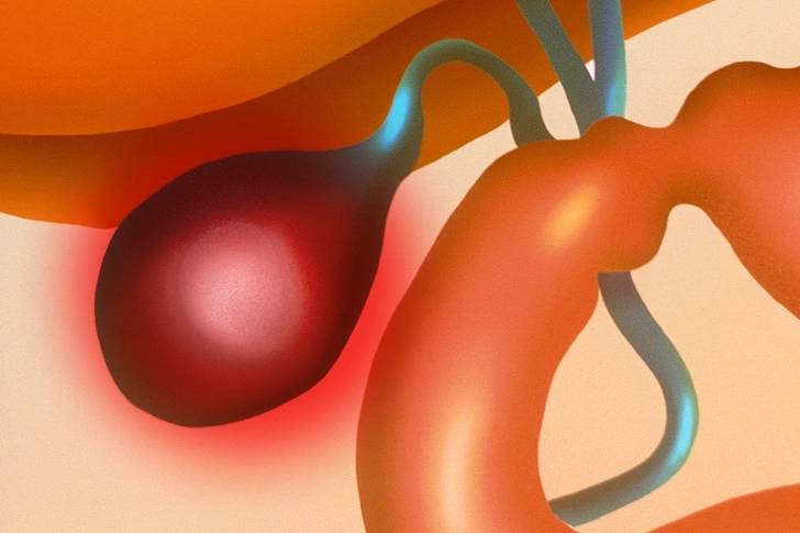 What Are Gallbladder Attacks?