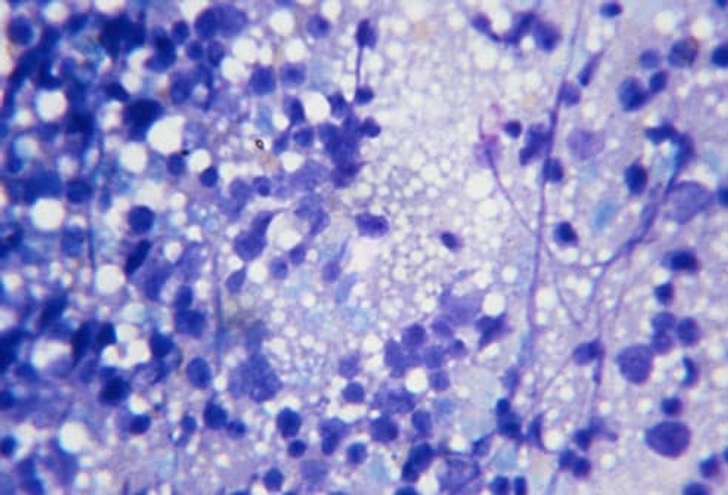 Diagnosis: Bone Marrow Test