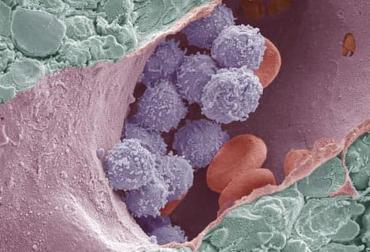 Cause: Aplastic Anemia