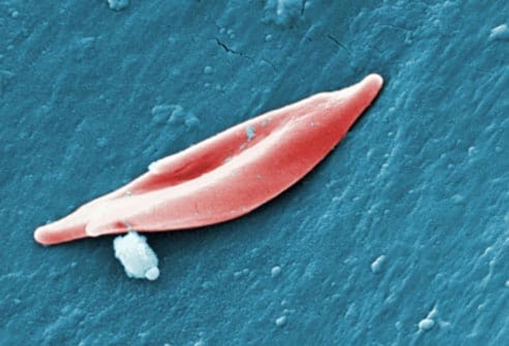 Sickle Cell Anemia Sickle Cell Anemia