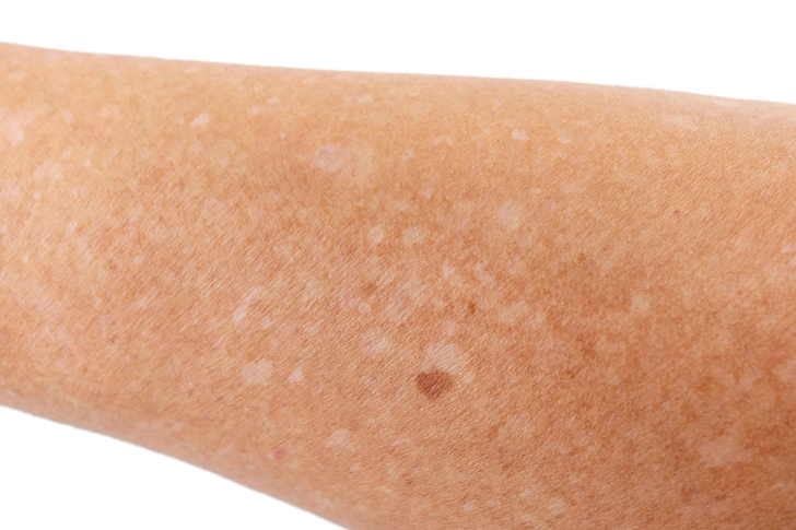For Uneven Skin Tone: AHAs, Retinoids