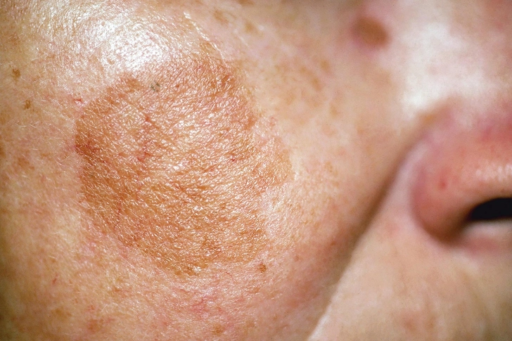 For Age Spots: Hydroquinone, Retinoids, Vitamin C, Kojic Acid For Age Spots: Hydroquinone, Retinoids, Vitamin C, Kojic Acid