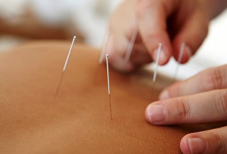 Acupuncture