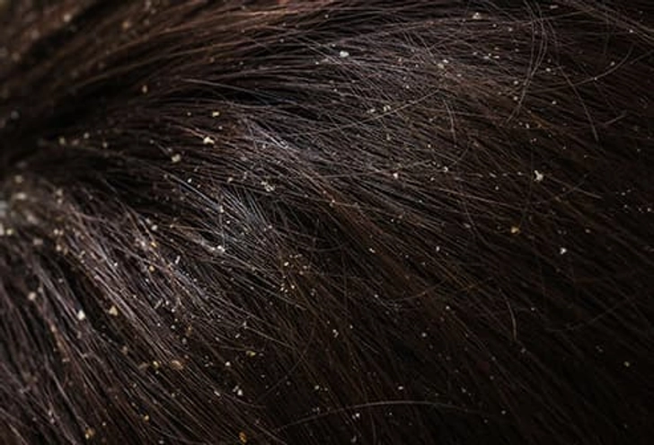 Dandruff Dandruff