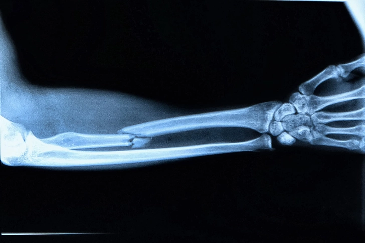 Broken Bone