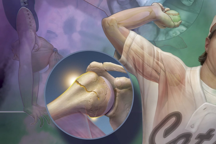 Stress Fractures