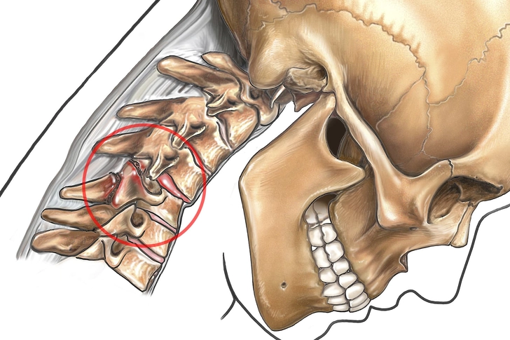 Herniated Disk
