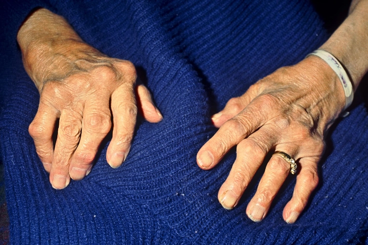 Osteoarthritis