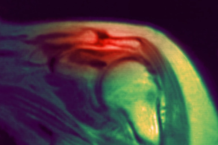 Impingement