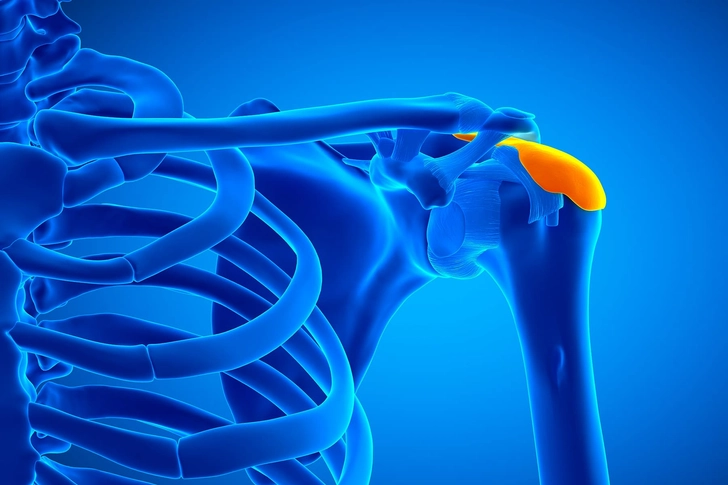Bursitis