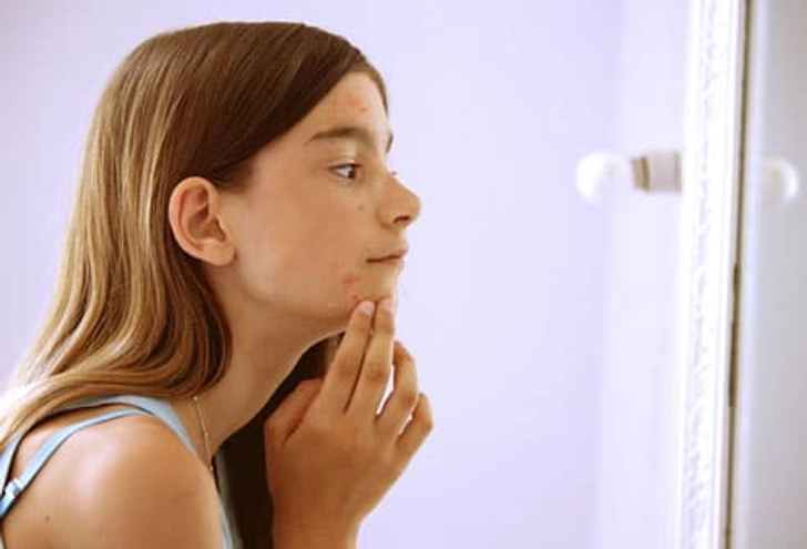 Acne: An Early Sign of Puberty Acne: An Early Sign of Puberty