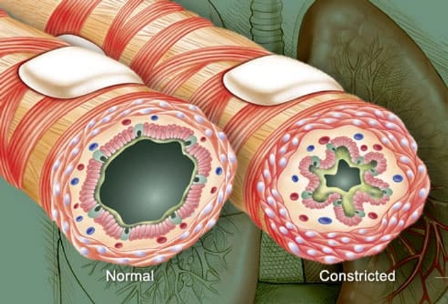 What Causes an Asthma Attack?