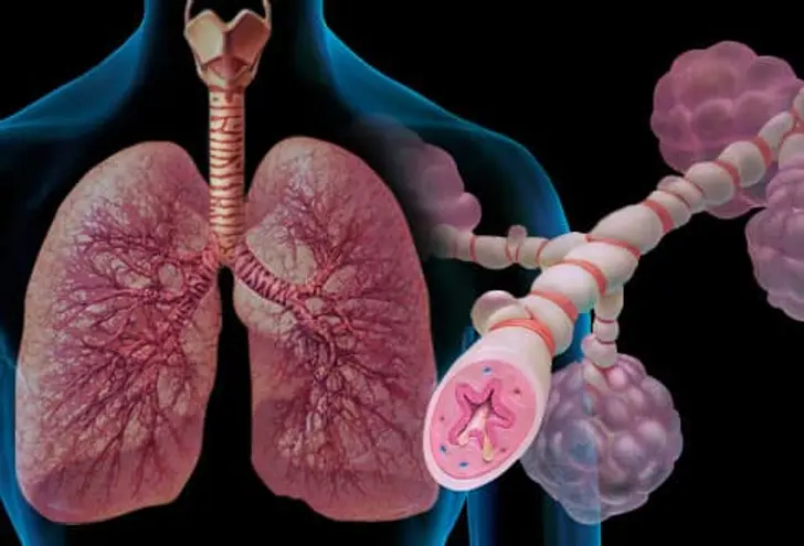 What Is Asthma?