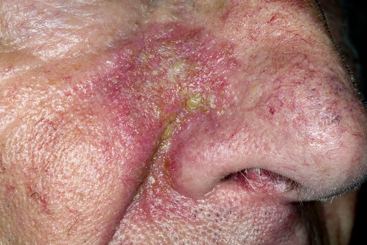 Rashes