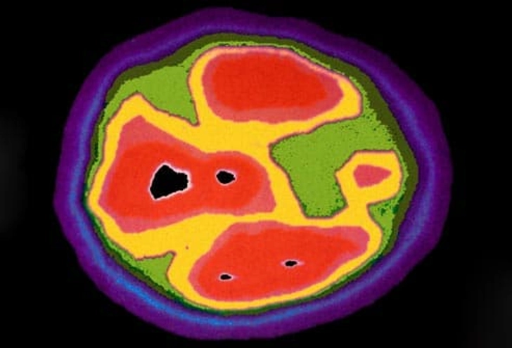 How Does Autism Affect the Brain?