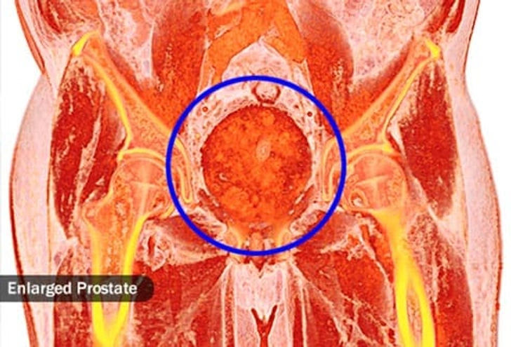 Improves Prostate